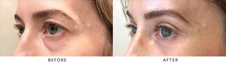 Lower Lid Blepharoplasty Before & After Photo - Patient Seeing Side - Patient 4B