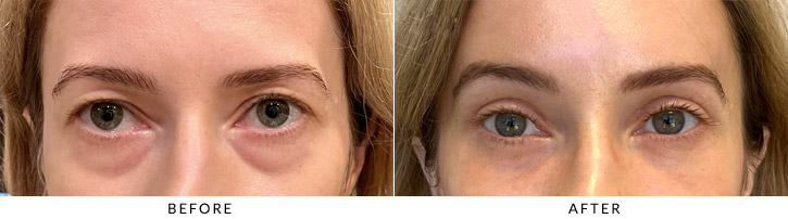 Lower Lid Blepharoplasty Before & After Photo - Patient Seeing Straight - Patient 4A