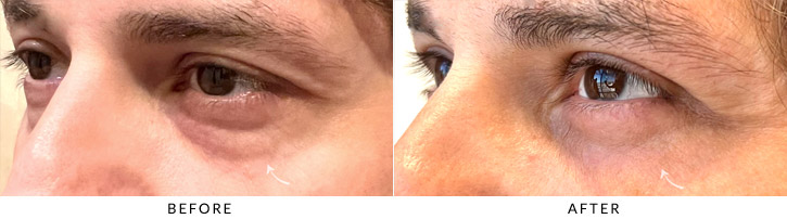 Lower Lid Blepharoplasty Before & After Photo - Patient Seeing Side - Patient 3C