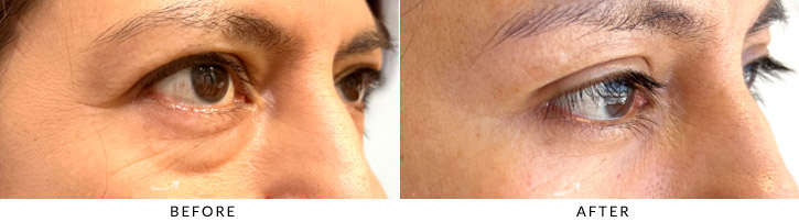 Lower Lid Blepharoplasty Before & After Photo - Patient Seeing Side - Patient 2C