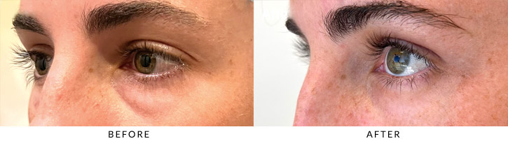 Lower Lid Blepharoplasty Before & After Photo - Patient Seeing Side - Patient 1C