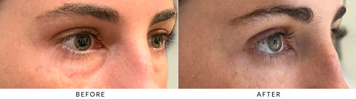 Lower Lid Blepharoplasty Before & After Photo - Patient Seeing Side - Patient 1D