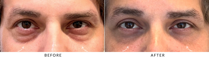 Lower Lid Blepharoplasty Before & After Photo - Patient Seeing Straight - Patient 3A