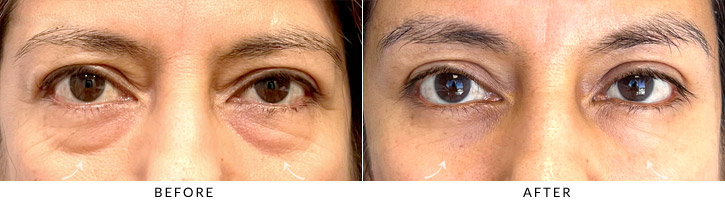 Lower Lid Blepharoplasty Before & After Photo - Patient Seeing Straight - Patient 2B
