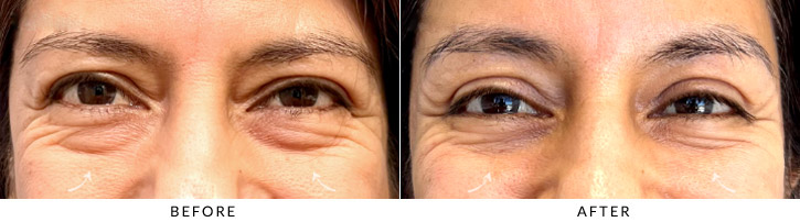 Lower Lid Blepharoplasty Before & After Photo - Patient Seeing Straight - Patient 2A