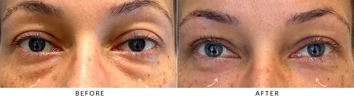 Lower Lid Blepharoplasty Before & After Photo - Patient Seeing Straight - Patient 5
