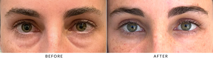 Lower Lid Blepharoplasty Before & After Photo - Patient Seeing Straight - Patient 1A