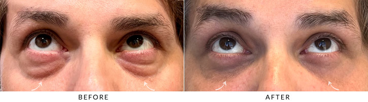Lower Lid Blepharoplasty Before & After Photo - Patient Seeing Up  - Patient 3B