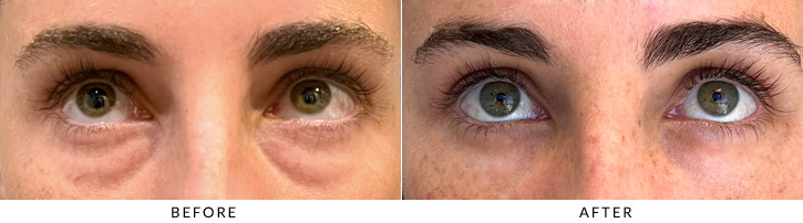 Lower Lid Blepharoplasty Before & After Photo - Patient Seeing Up  - Patient 1B