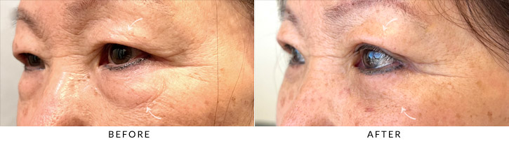 Quad Blepharoplasty Before & After Photo - Patient Seeing Side - Patient 4C