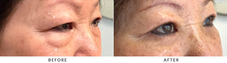 Quad Blepharoplasty Before & After Photo - Patient Seeing Side - Patient 4D