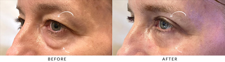 Quad Blepharoplasty Before & After Photo - Patient Seeing Side - Patient 3B