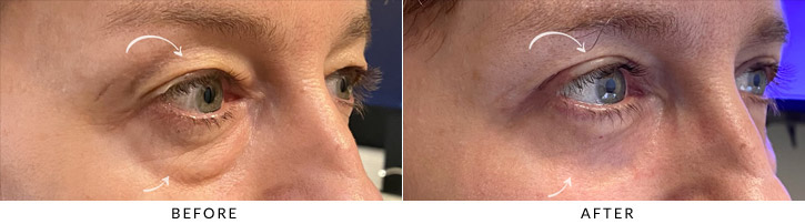 Quad Blepharoplasty Before & After Photo - Patient Seeing Side - Patient 3C