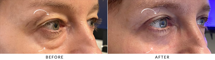Quad Blepharoplasty Before & After Photo - Patient Seeing Side - Patient 3C