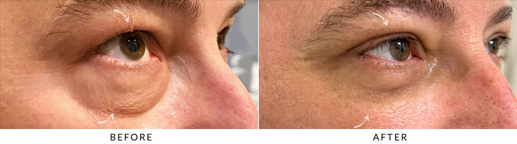 Quad Blepharoplasty Before & After Photo - Patient Seeing Side - Patient 2C