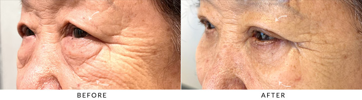 Quad Blepharoplasty Before & After Photo - Patient Seeing Side - Patient 1C