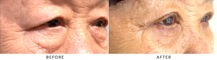 Quad Blepharoplasty Before & After Photo - Patient Seeing Side - Patient 1D