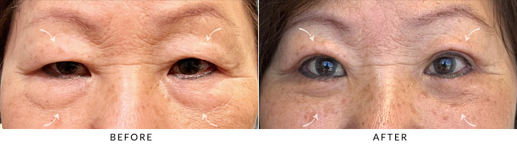 Quad Blepharoplasty Before & After Photo - Patient Seeing Straight - Patient 4A