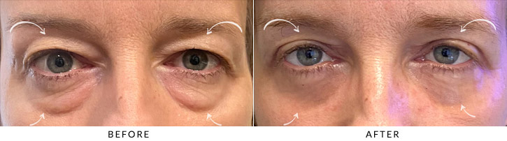 Quad Blepharoplasty Before & After Photo - Patient Seeing Straight - Patient 3A