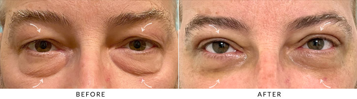 Quad Blepharoplasty Before & After Photo - Patient Seeing Straight - Patient 2A
