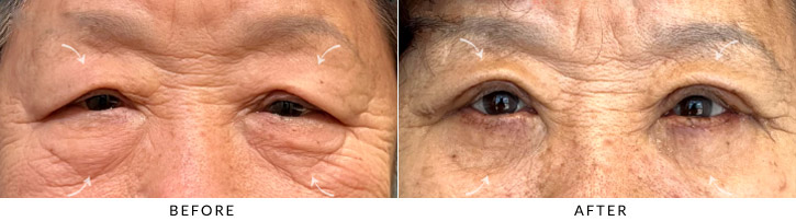 Quad Blepharoplasty Before & After Photo - Patient Seeing Straight - Patient 1A
