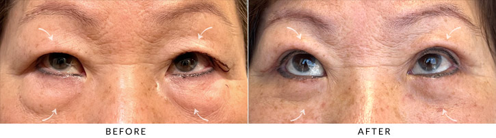 Quad Blepharoplasty Before & After Photo - Patient Seeing Up  - Patient 4B