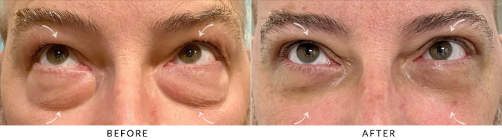 Quad Blepharoplasty Before & After Photo - Patient Seeing Up  - Patient 2B