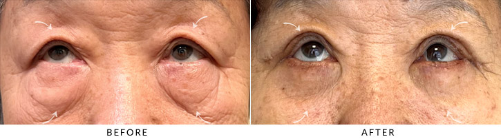 Quad Blepharoplasty Before & After Photo - Patient Seeing Up  - Patient 1B