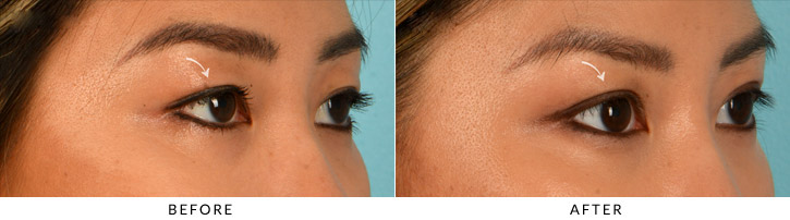 Upper Lid Blepharoplasty Before & After Photo - Patient Seeing Side - Patient 6C