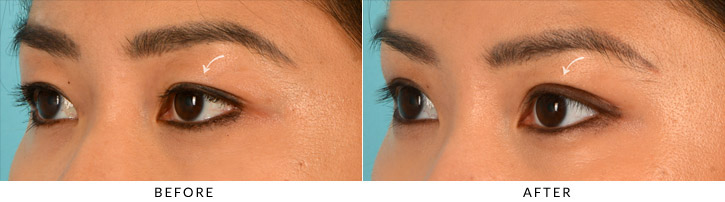 Upper Lid Blepharoplasty Before & After Photo - Patient Seeing Side - Patient 6D
