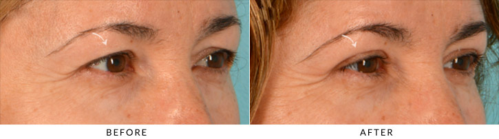 Upper Lid Blepharoplasty Before & After Photo - Patient Seeing Side - Patient 1C