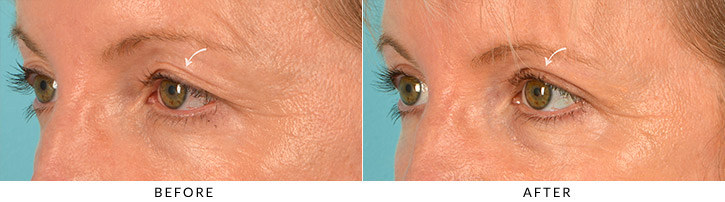 Upper Lid Blepharoplasty Before & After Photo - Patient Seeing Side - Patient 2C