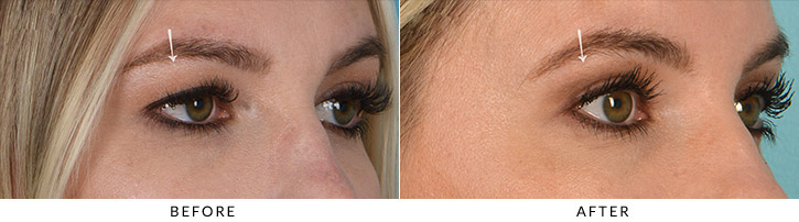 Upper Lid Blepharoplasty Before & After Photo - Patient Seeing Side - Patient 3B