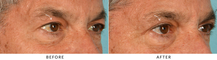 Male Blepharoplasty Before & After Photo - Patient Seeing Side - Patient 2C