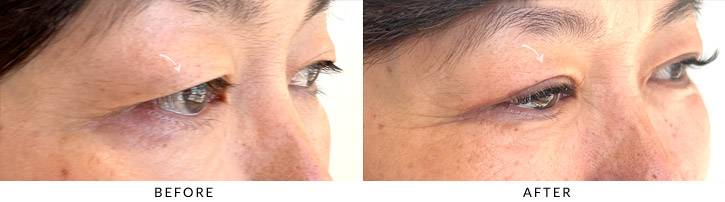 Upper Lid Blepharoplasty Before & After Photo - Patient Seeing Side - Patient 5B