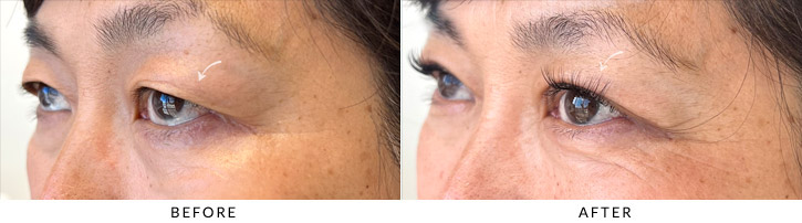 Upper Lid Blepharoplasty Before & After Photo - Patient Seeing Side - Patient 5C