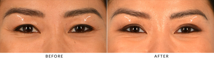 Upper Lid Blepharoplasty Before & After Photo - Patient Seeing Straight - Patient 6B