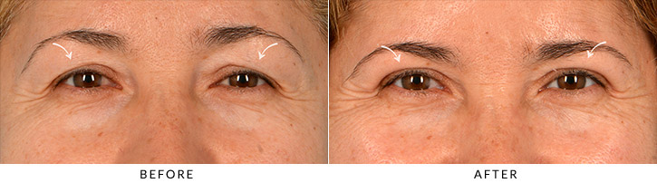 Upper Lid Blepharoplasty Before & After Photo - Patient Seeing Straight - Patient 1A