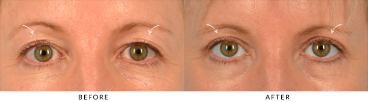 Asian Eyelid (Double Eyelid) Surgery Before & After Photo - Patient Seeing Straight - Patient 2A