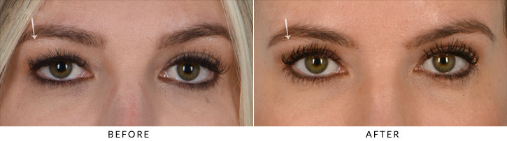 Upper Lid Blepharoplasty Before & After Photo - Patient Seeing Straight - Patient 3A
