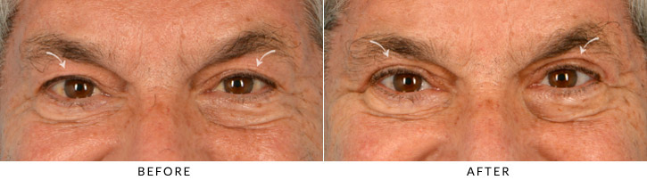 Upper Lid Blepharoplasty Before & After Photo - Patient Seeing Straight - Patient 4A