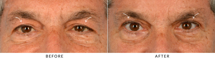 Male Blepharoplasty Before & After Photo - Patient Seeing Straight - Patient 2B