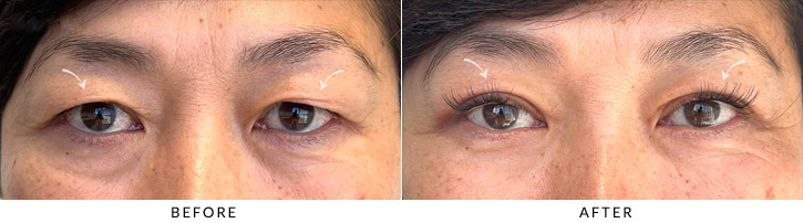 Upper Lid Blepharoplasty Before & After Photo - Patient Seeing Straight - Patient 5A