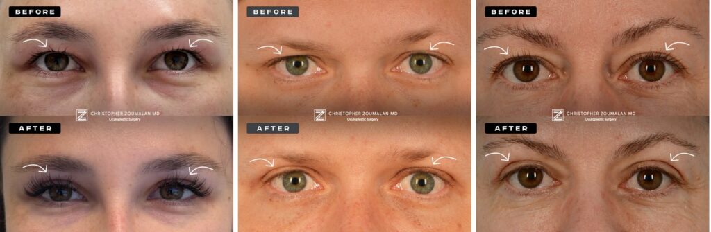 photos showing before and after surgery for hooded eyelids