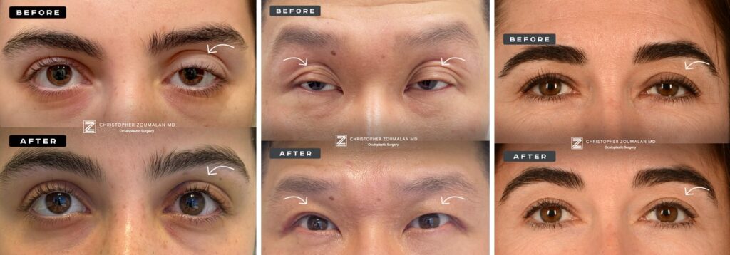 photos showing before and after ptosis repair surgery