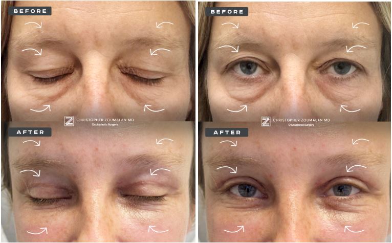 BellaLiftBefore&Afterimge1