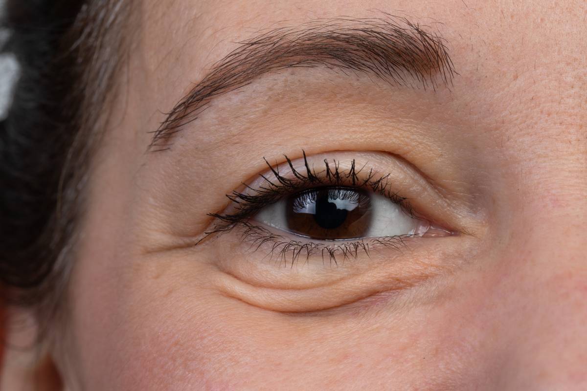 Close-up of a female with heavy under eye bags.